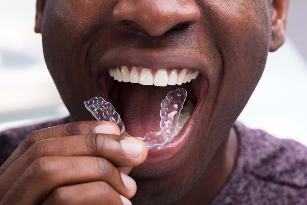 Man putting retainer in after orthodontic treatment - Smile at the World Orthodontics Temple Texas
